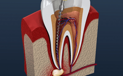 Illustration of performing root canal therapy in Texarkana, TX