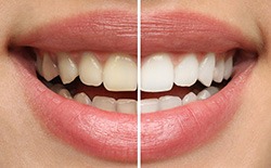 A woman before and after teeth whitening