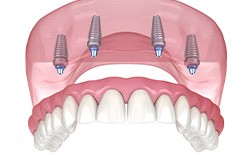 Illustration of an implant denture