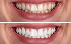 A smile before and after teeth whitening