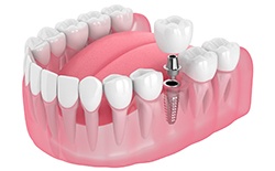 parts of a dental implant in Texarkana