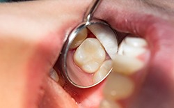 restoration of dental implant in Texarkana