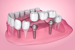 Digital illustration of an implant bridge