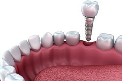 Diagram of how dental implants work in Texarkana 