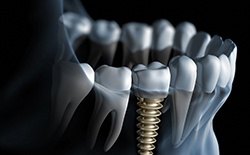 Diagram of dental implants in Texarkana 