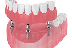 Diagram showing how implant dentures in Texarkana work 