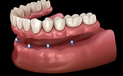 Model of implant supported denture