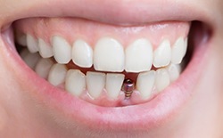 A smile that has just received a dental implant