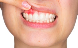 close-up of woman with gum disease in Texarkana