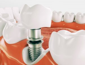 Dental implants graphic