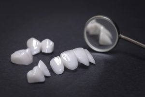 model of crowns and tooth replacement bridge