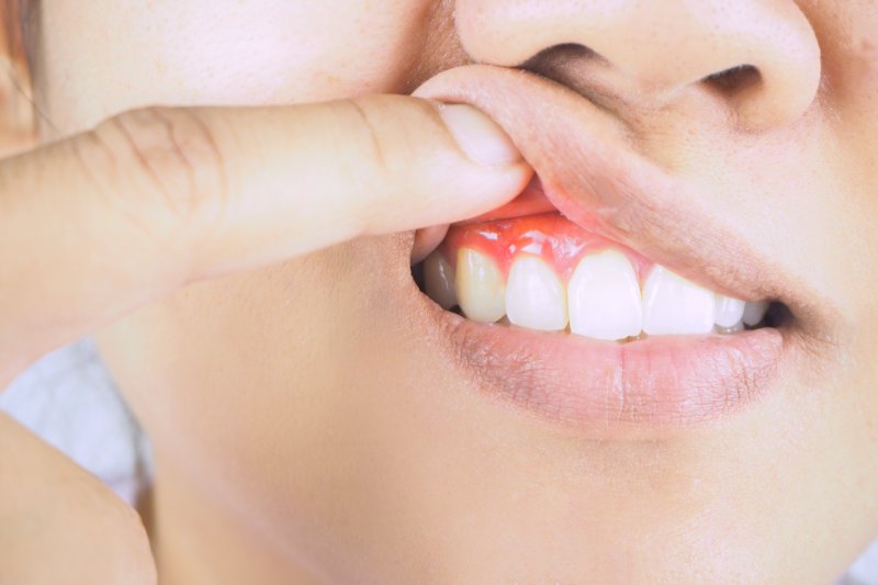 Woman with gum disease pushing her lip upwards