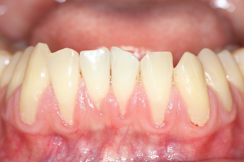 Gums that receded due to gum disease.