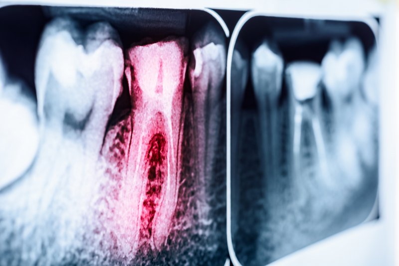 An X-ray of an infected and decayed tooth